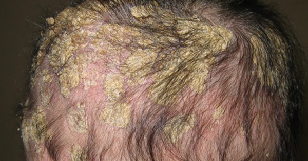 Atopitchesky la dermatite sur les coudes